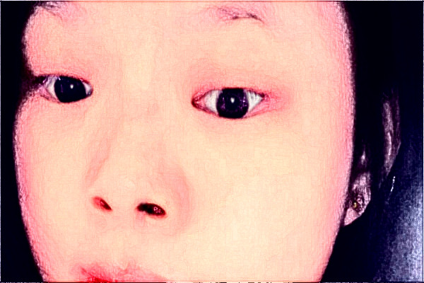 2024南京中大医院激光除皱做的怎么样【整形案例分享】