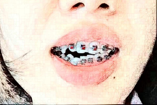 2024哈尔滨医科大学附属第二医院牙齿矫正做的好不好【牙齿矫正案例反馈】