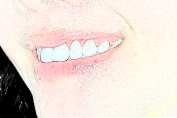 大连中山医院口腔科单颗牙种植可以做吗?做的好不好