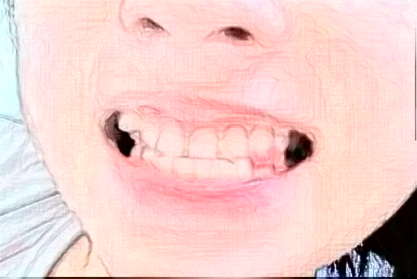 2024天津市第三中心医院口腔科固定义齿做的好吗?整形日记分享