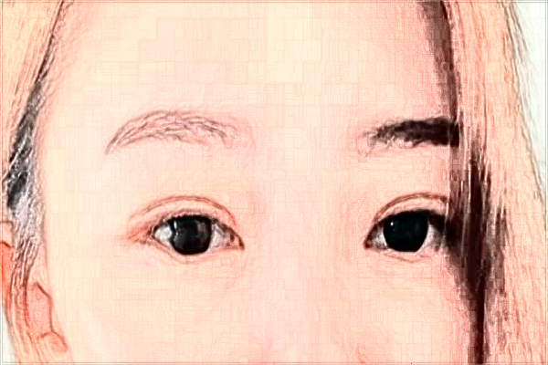 2024宁波李惠利医院割双眼皮怎么样_案例+价格