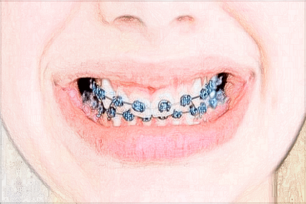 2024山东省千佛山医院正畸科价格?正畸科的范围包括什么