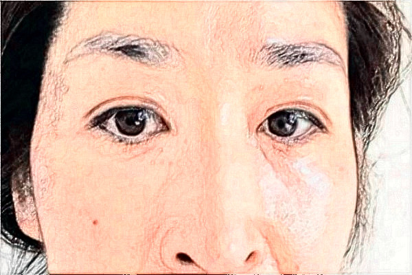 2024南京鼓楼医院去眼袋怎么样_体验日记分享