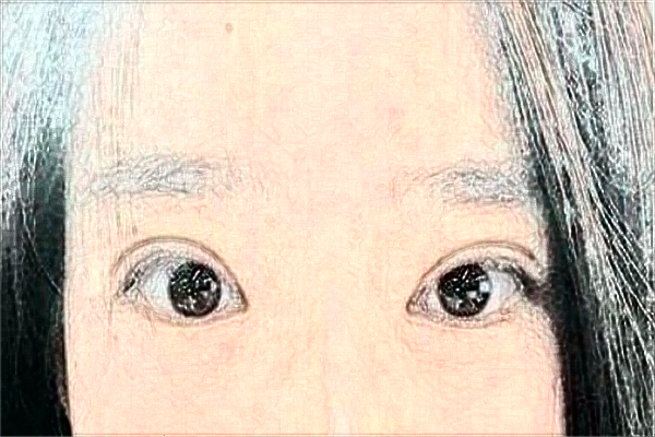 2024大连医科大学附属第一医院做双眼皮做的好吗_医生技术好不好