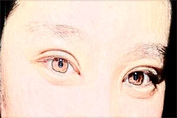 2024大连医科大学附属第一医院做双眼皮做的好吗_医生技术好不好