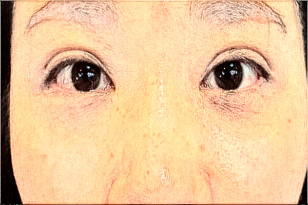 2024天津市医科大学眼科医院全飞秒做的好吗?谁做得好