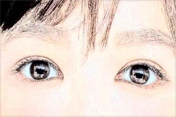 2024大连医科大学附属第一医院做双眼皮做的好吗?整形日记分享