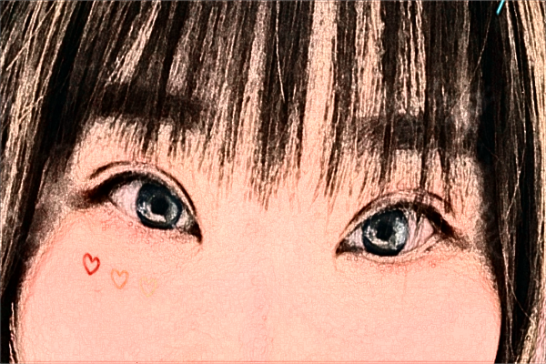 2024大连医科大学附属第一医院做双眼皮做的好吗?整形日记分享