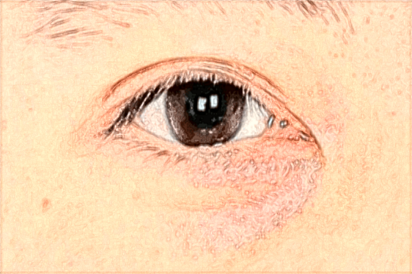 2024佛山市禅城区中心医院热玛吉价格?热玛吉是什么