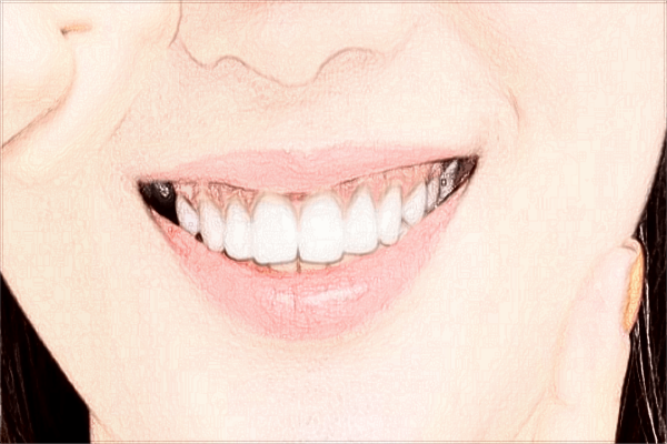 佛山市第二人民医院牙科好吗?2024牙科种植牙收费标准?