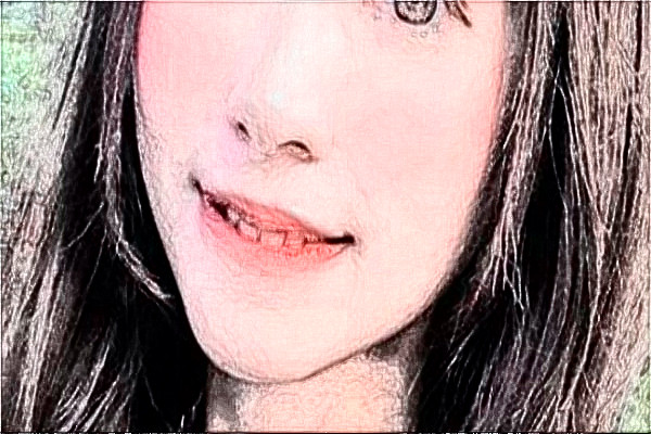 南通大学附属医院去胎记怎么样_体验日记分享