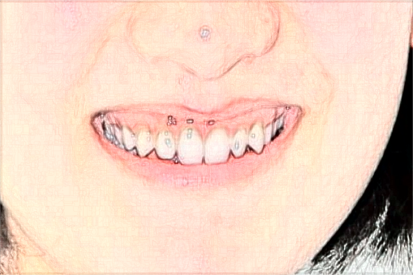 南京中大医院牙齿矫正做的怎么样_谁做的比较好