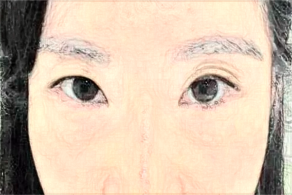 河北省人民医院去眼袋需要多少钱?医生推荐