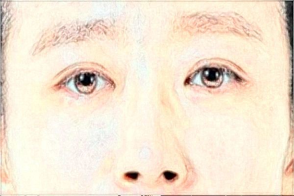 河北省人民医院去眼袋需要多少钱?医生推荐