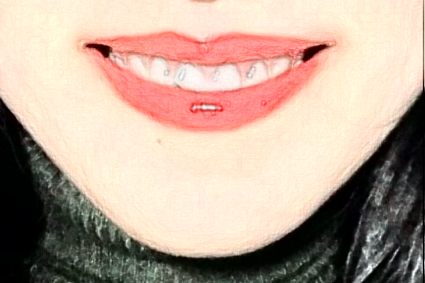 2024吉林大学第一医院隐形矫正价格多少?做的怎么样