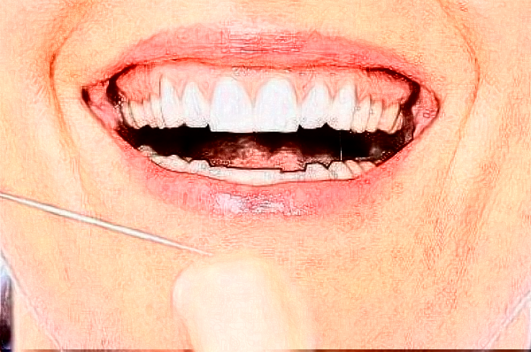 安徽省立医院根管加牙冠多少钱?做的好吗?