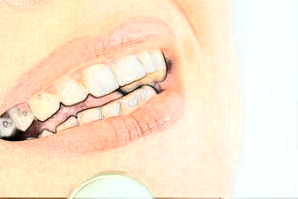 2024郑州唯美口腔医院烤瓷牙怎么样【烤瓷牙案例分享】