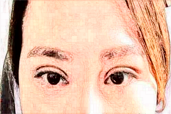 烟台毓璜顶医院整形美容科谁做鼻子做得好?隆鼻案例