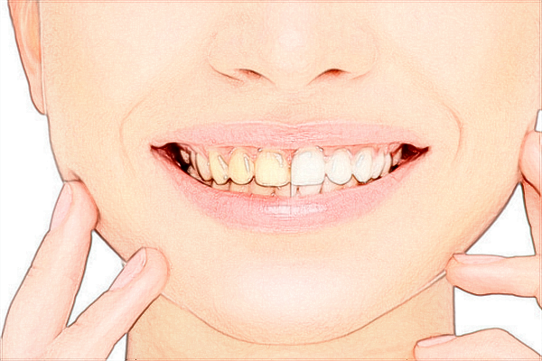 2024惠州市中心人民医院矫正牙齿费用?牙齿矫正有用吗