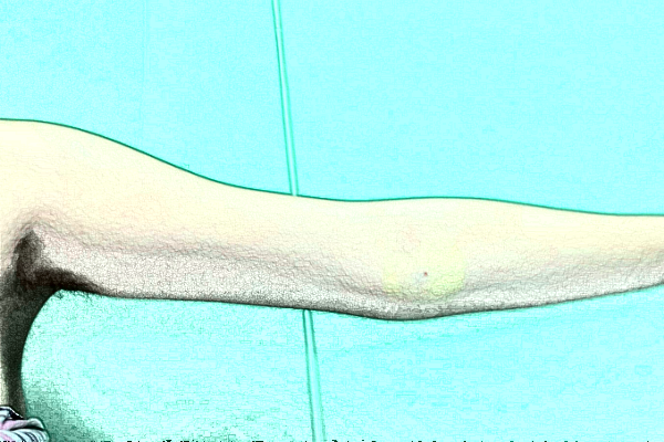 南京鼓楼医院吸脂怎么样_体验日记分享