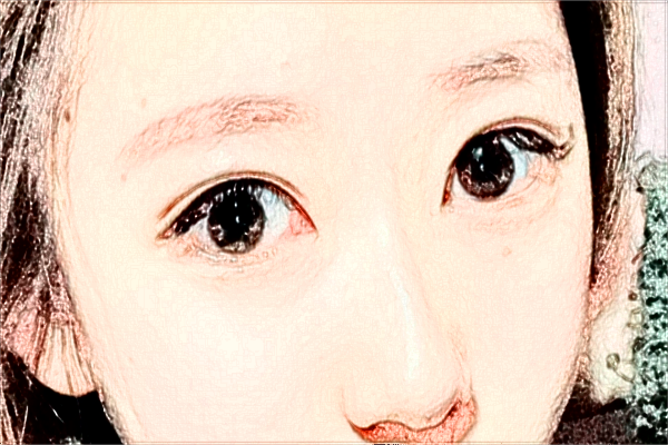 2024海口市人民医院飞秒手术价格?飞秒手术后注意事项