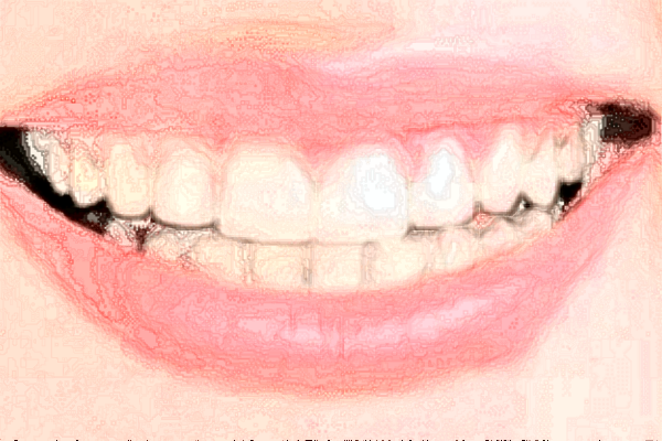 2024山西省人民医院烤瓷牙费用多少?整形日记全过程