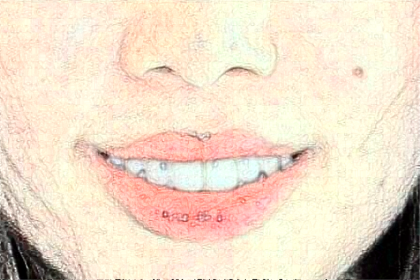 2024天津南开医院全瓷牙做的好吗?哪位医生做得好