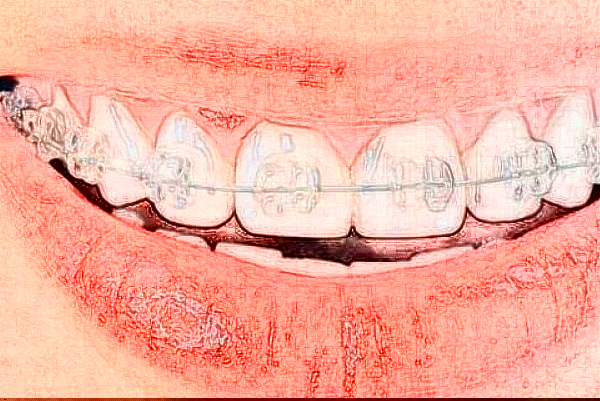 成都新桥口腔医院种植牙怎么样?种植牙品牌选择