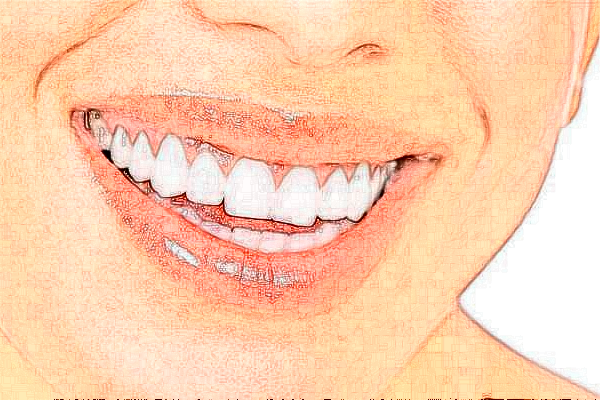 杭州植得口腔门诊部镶牙怎么样?医生介绍_案例分享