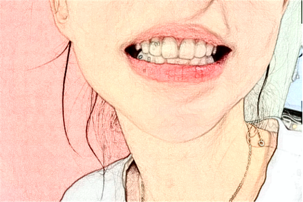 襄阳新德恩口腔门诊部种植牙怎么样_谁做得好