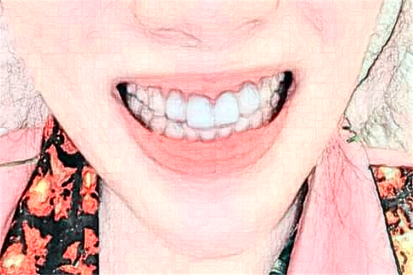 苏州姑苏美奥口腔地包天矫正费用多少_真实案例反馈