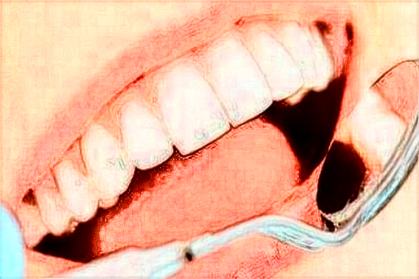 自贡华医口腔医院矫正牙哪个医生好?矫正牙保持器需要戴多久