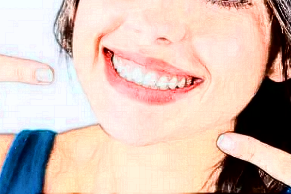 自贡华医口腔医院洗牙怎么样?洗牙结石多少钱一次?