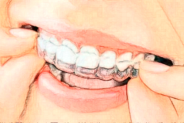 铜陵市人民医院冷光美白怎么样_案例分享