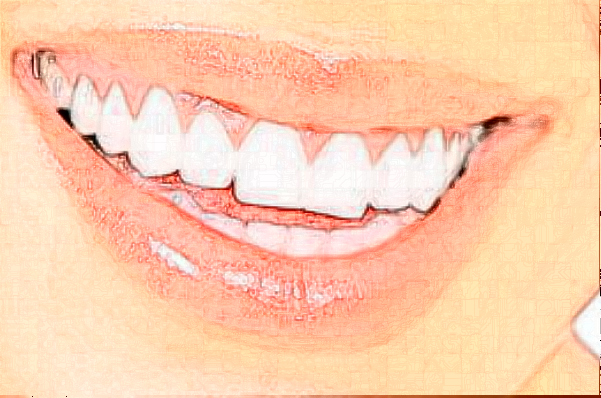 福州福能海峡口腔医院冷光美白多少钱_案例反馈