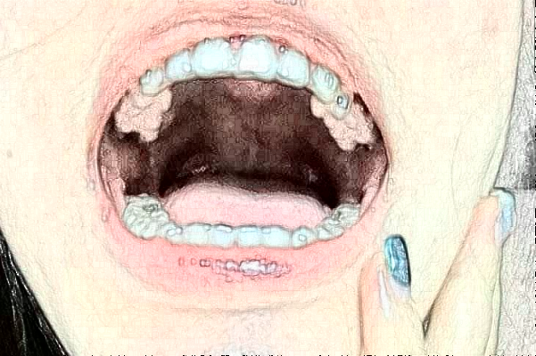2024襄阳新德恩口腔门诊部牙齿美白费用多少_真实案例反馈