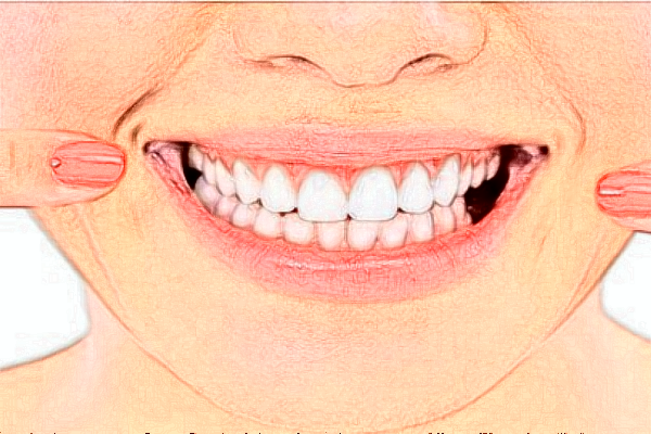 2022延安牙卫士口腔牙齿矫正费用多少_真实案例反馈