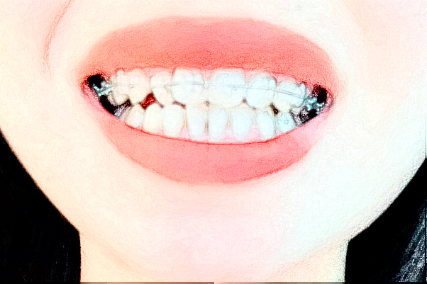 2024重庆世纪美奥口腔医院全瓷牙费用?全瓷牙能用多久