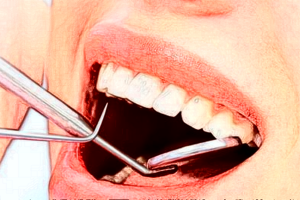 武汉德韩口腔医疗洗牙怎么洗的?附洗牙案例