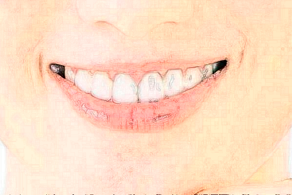宣城大医医院瓷贴面有哪几种?瓷贴面牙齿有危害吗