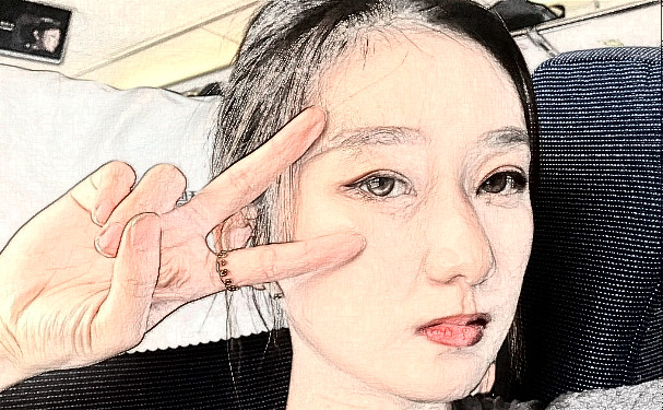 宝鸡高新开发区爱容妍医疗美容门诊部玻尿酸填充技术怎么样?术后三个月案例点评|费用查询