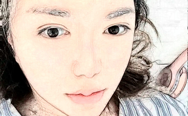 南京美范医疗美容诊所玻尿酸填充下巴90天案例反馈(效果怎么样?技术亮点)