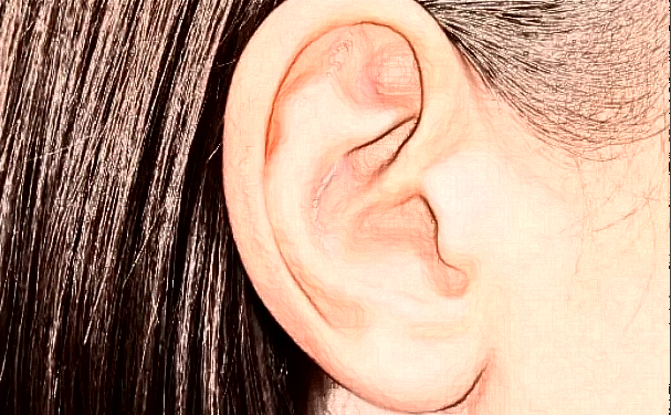 苏州薇琳美容医院招风耳整形半年亲测案例全解|技术能力怎么样?多少钱