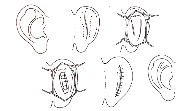 华中科技大学同济医学院医院杯状耳矫正术后三个月案例曝光|技术能力怎么样?费用多少