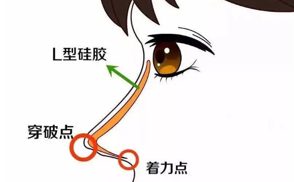 重庆玛恩医疗美容医院膨体隆鼻价格明细?技术评测怎么样?