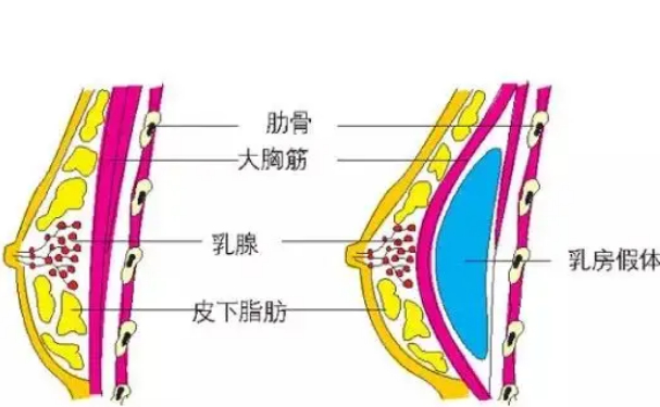 张家港唯恩医疗美容医院隆胸技术级别怎么样?150天术后案例展示