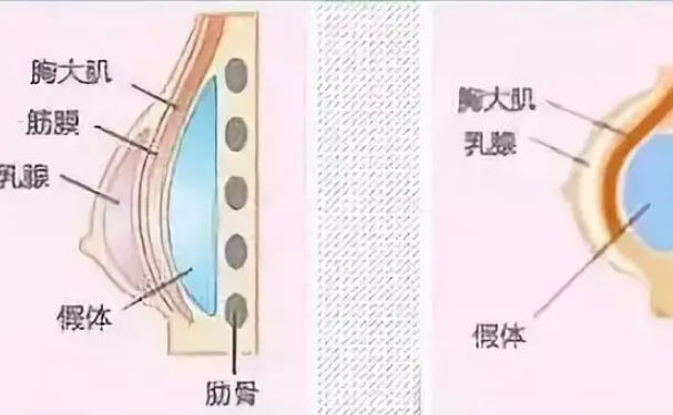 上海万丽医疗美容门诊部女性隆胸技术怎么样?120天术后恢复案例