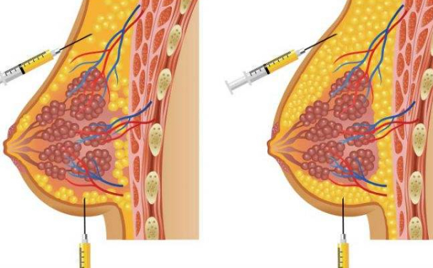 华中科技大学同济医学院医院注射隆胸技术怎么样?术后一年恢复案例