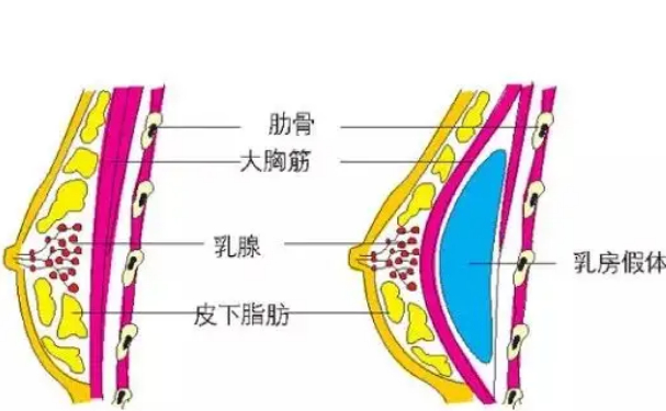 紫洁俪方（北京）医疗美容诊所硅胶隆胸需要多少钱?技术评价&术后三个月案例反馈