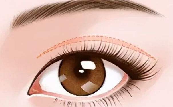 宁波壬美整形医院做双眼皮技术特点怎么样?120天经典案例